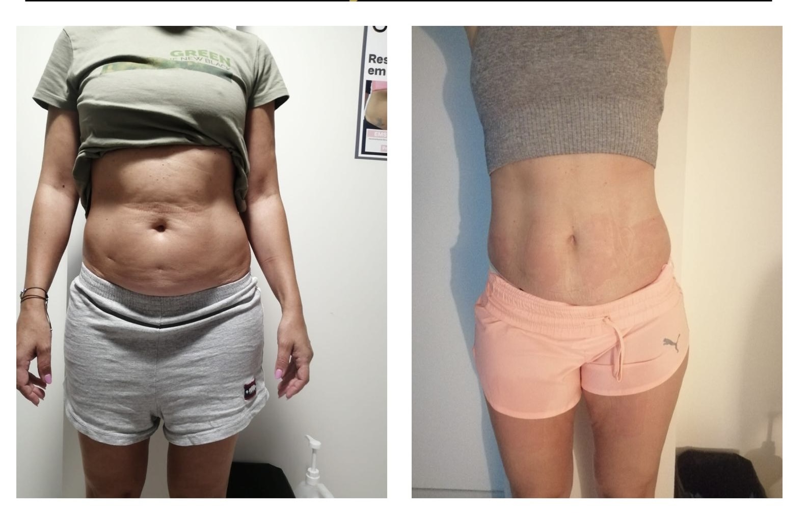Before After