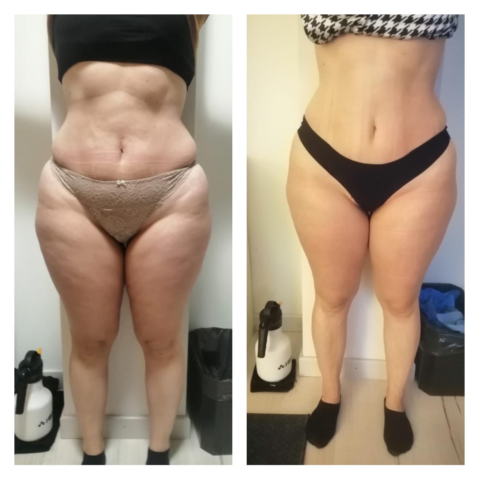 Before After