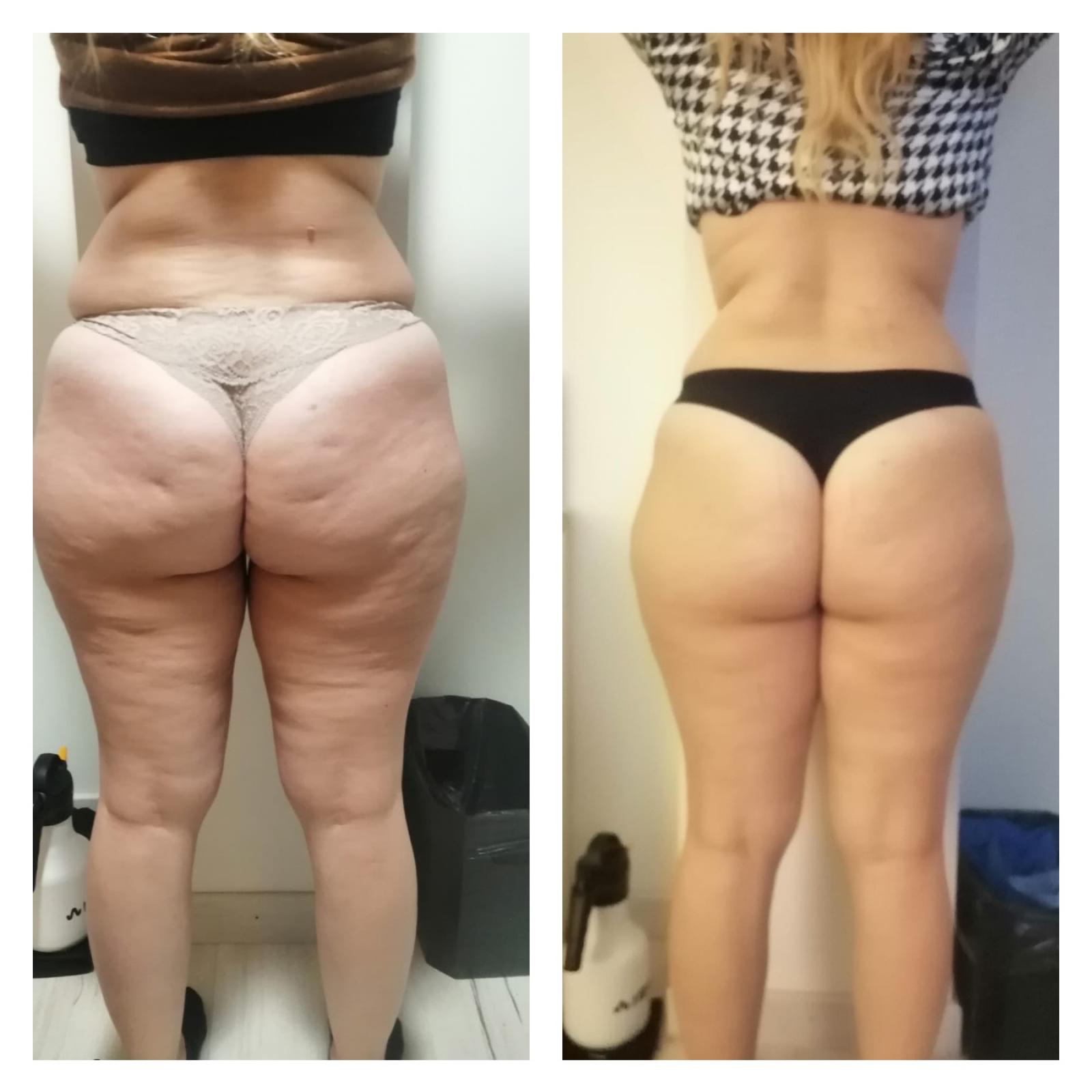 Before After