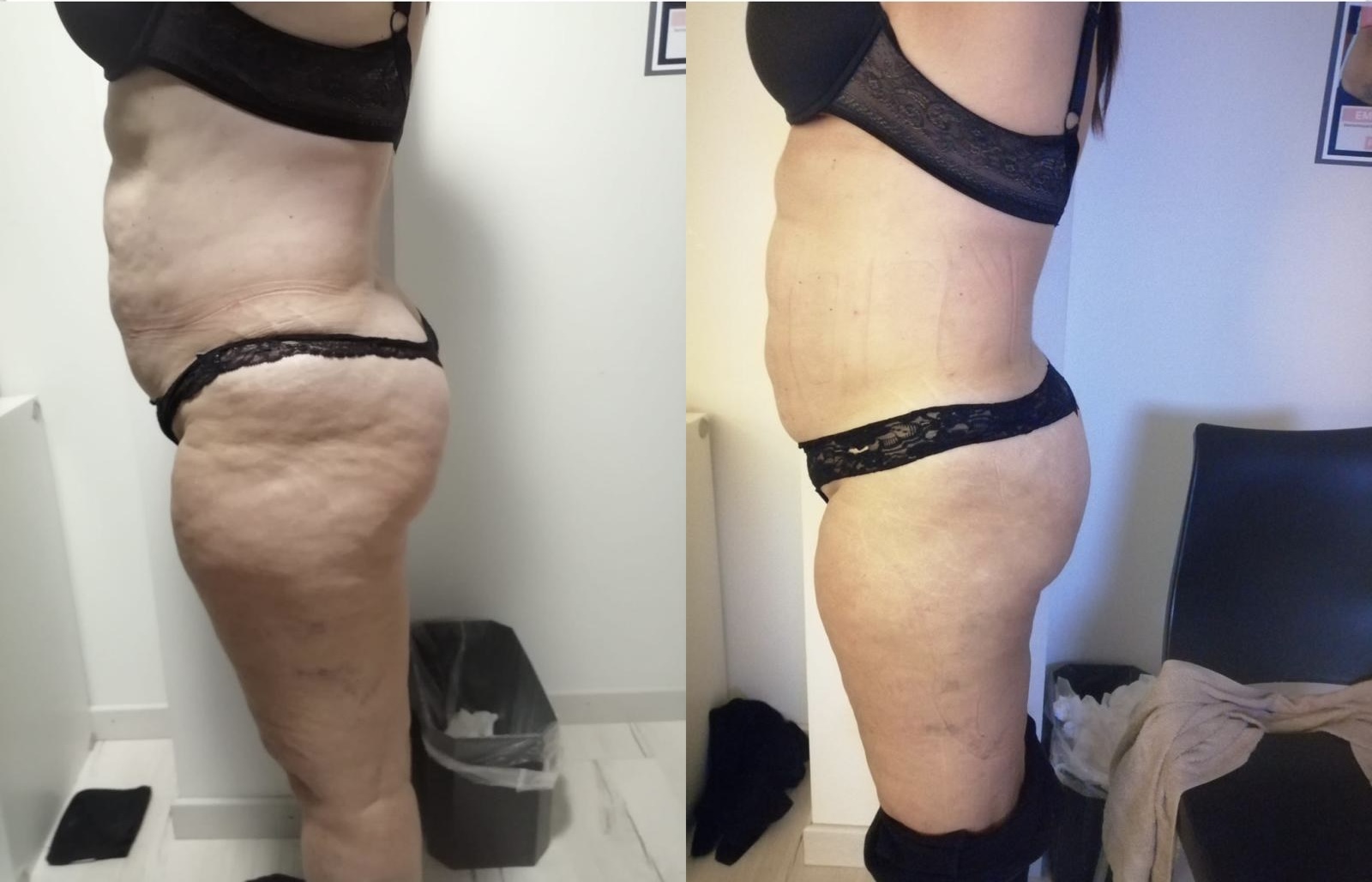 Before After
